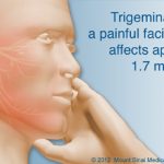 Trigeminal Neuralgia, Treatments for Trigeminal Neuralgia, neurosurgery, painful facial condition, Mount Sinai
